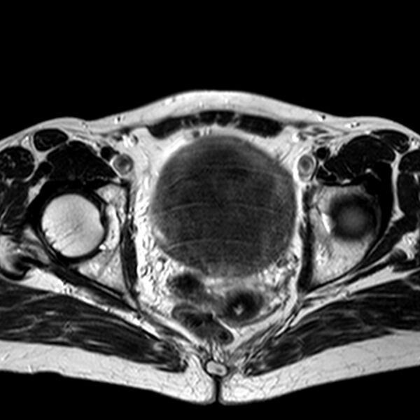 File:Adenomyoma of the uterus (huge) (Radiopaedia 9870-10438 Axial T2 14).jpg