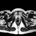 Adenomyoma of the uterus (huge) (Radiopaedia 9870-10438 Axial T2 6).jpg