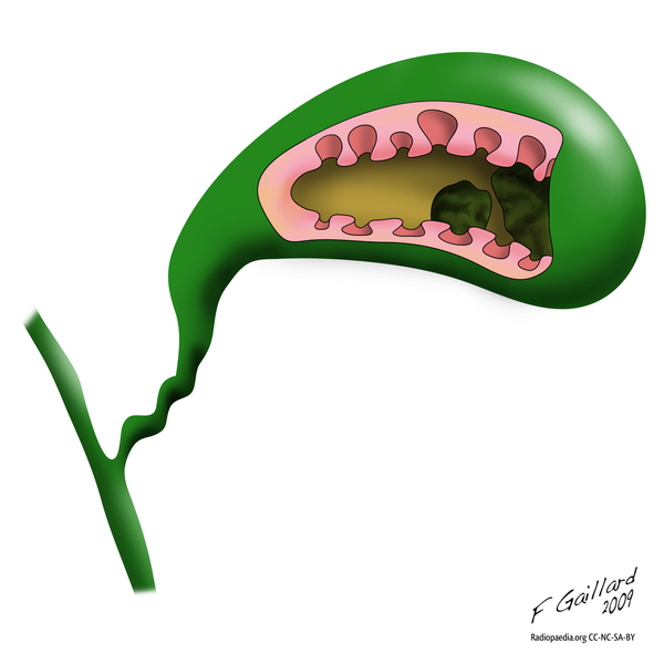 File:Adenomyomatsis (illustration) (Radiopaedia 7928).png