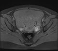 Adenomyosis - ovarian endometriomas (Radiopaedia 67031-76350 Axial T1 fat sat 16).jpg