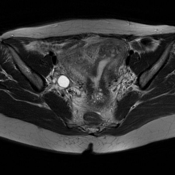 File:Adenomyosis within a septate uterus (Radiopaedia 69963-79981 Axial T2 18).jpg