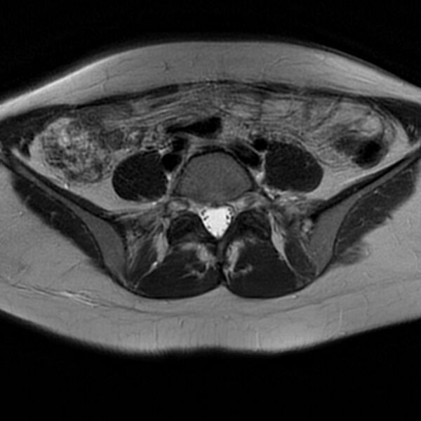 File:Adenomyosis within a septate uterus (Radiopaedia 69963-79981 Axial T2 7).jpg