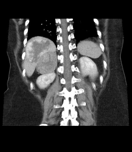 File:Adrenal cortical carcinoma with IVC invasion and thrombosis (Radiopaedia 34307-35597 Coronal C+ portal venous phase 38).jpg