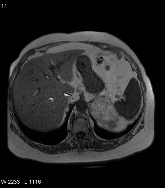 File:Adrenal myelolipoma (Radiopaedia 6765-7961 Axial T1 in-phase 11).jpg