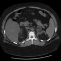 Adrenal myelolipoma (Radiopaedia 8216-9068 Axial non-contrast 19).jpg