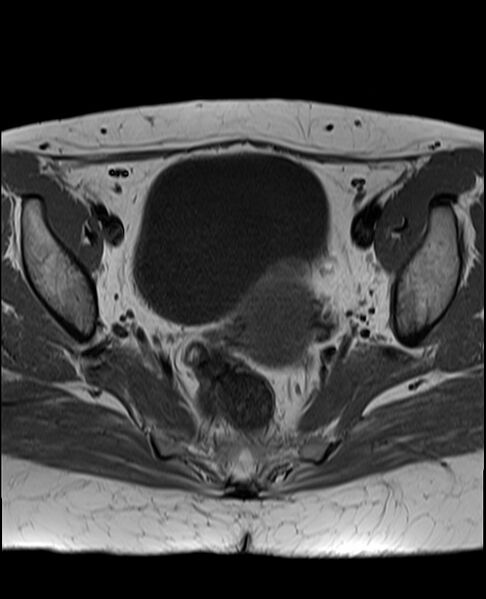File:Adult granulosa cell tumor of the ovary (Radiopaedia 71581-81950 Axial T1 15).jpg