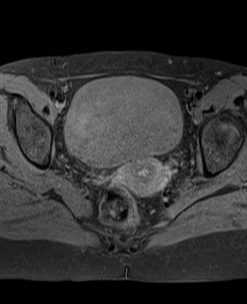 File:Adult granulosa cell tumor of the ovary (Radiopaedia 71581-81950 Axial T1 fat sat 17).jpg