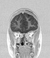 Aicardi syndrome (Radiopaedia 66029-75205 Coronal T1-IR 5).jpg