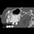 Ameloblastic fibro-odontoma (Radiopaedia 18843-18780 bone window 8).jpg