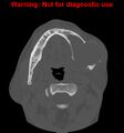 Ameloblastoma (Radiopaedia 13276-13280 Axial non-contrast 10).jpg