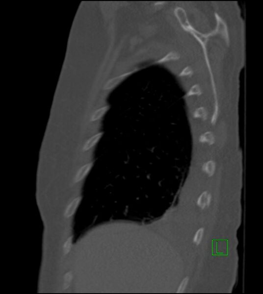 File:Amiodarone deposition in the liver (Radiopaedia 77587-89780 Sagittal bone window 81).jpg