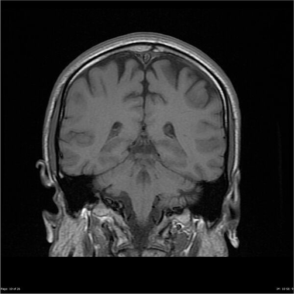 File:Amnestic syndrome secondary to hypoxic brain injury (Radiopaedia 24743-25004 B 10).jpg