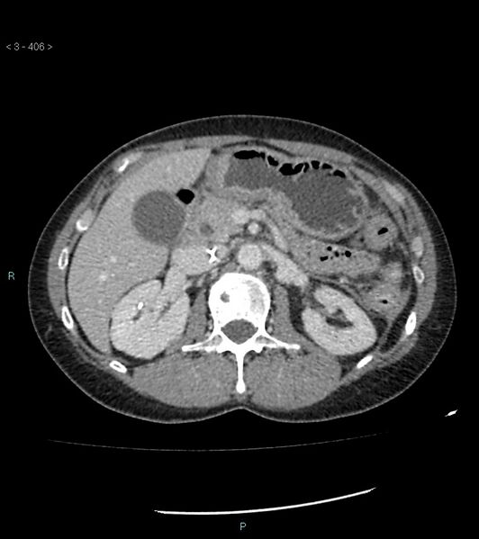 File:Ampulla of Vater metastasis (Radiopaedia 27820-28069 A 44).jpg