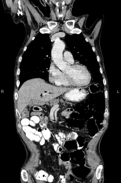 File:Ampullary adenocarcinoma (Radiopaedia 86093-102033 D 18).jpg