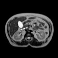 Ampullary tumor (Radiopaedia 27294-27479 T2 8).jpg