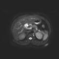 Ampullary tumor (Radiopaedia 27294-27479 T2 SPAIR 11).jpg