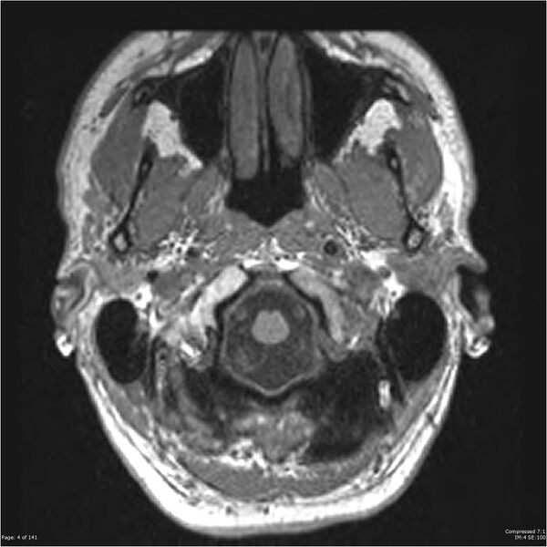 File:Anaplastic meningioma with recurrence (Radiopaedia 34452-35788 Axial T1 2).jpg