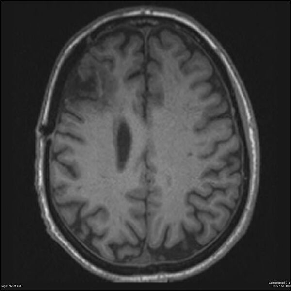 File:Anaplastic meningioma with recurrence (Radiopaedia 34452-35788 Axial T1 95).jpg