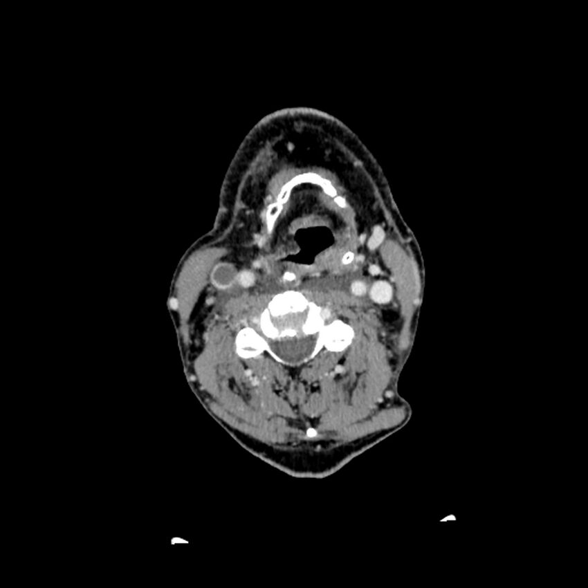 Anaplastic thyroid carcinoma (Radiopaedia 79087-92034 B 68).jpg