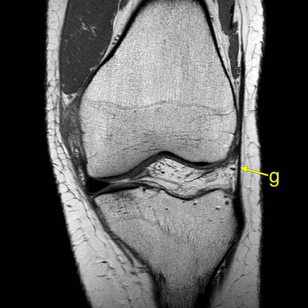 File:Anatomy Quiz (MRI knee) (Radiopaedia 43478-46874 A 11).jpeg