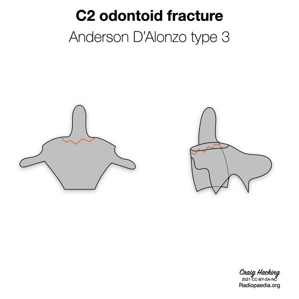 File:Anderson and D'Alonzo classification of C2 odontoid fractures (diagrams) (Radiopaedia 87249-103528 types 4).jpeg