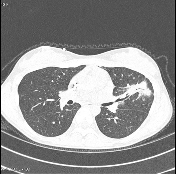 File:Angioinvasive aspergillosis (Radiopaedia 8651-15074 Axial lung window 4).jpg