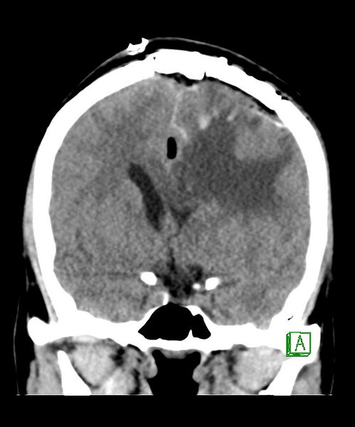 File:Angiomatous meningioma (Radiopaedia 79459-92578 Coronal non-contrast 17).jpg