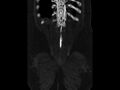 Ankylosing spondylitis (Radiopaedia 44609-48357 Coronal bone window 97).jpg