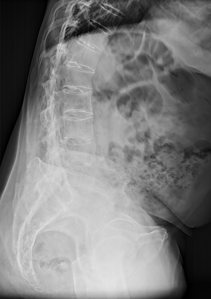 File:Ankylosing spondylitis with dagger sign (Radiopaedia 61271-69171 D 1).PNG