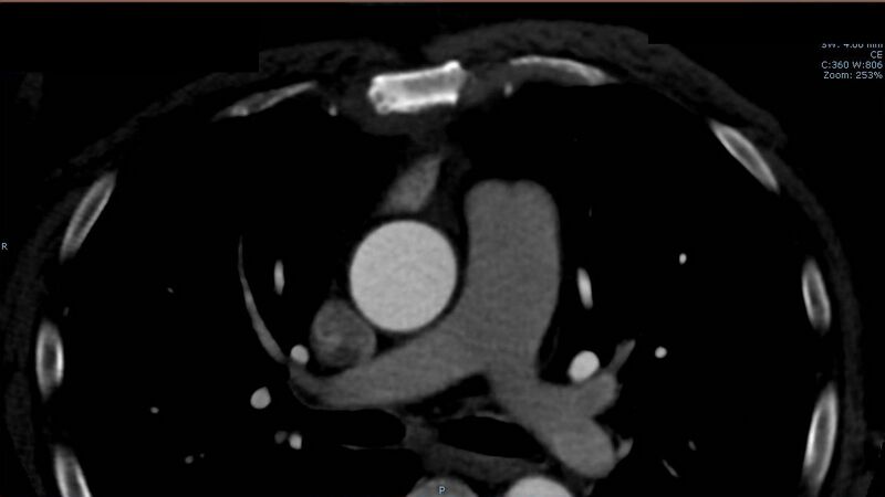 File:Anomalous left coronary artery- prepulmonic course (Radiopaedia 29253-29667 A 1).JPG