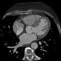 Anomalous origin of left circumflex artery from right coronary sinus (Radiopaedia 72563-83117 B 74).jpg
