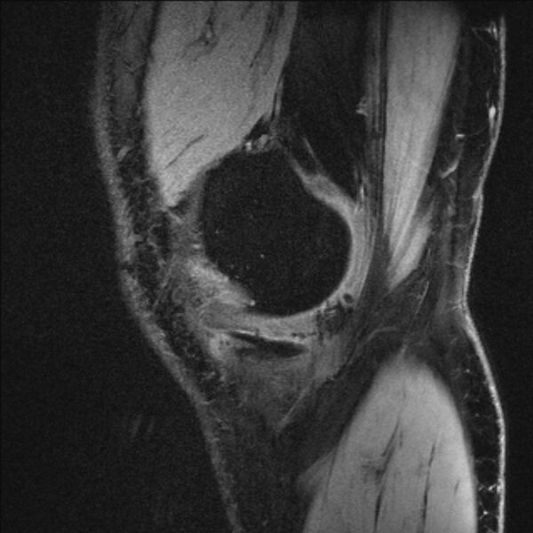 File:Anterior cruciate ligament mucoid degeneration (Radiopaedia 68400-77933 Sagittal 58).jpg