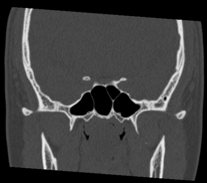 File:Antrochoanal polyp (Radiopaedia 21894-21868 Coronal bone window 29).jpg