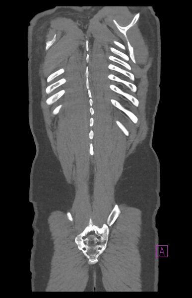 File:Aortectomy and axillary-bifemoral bypass (Radiopaedia 28303-28545 C 84).jpg