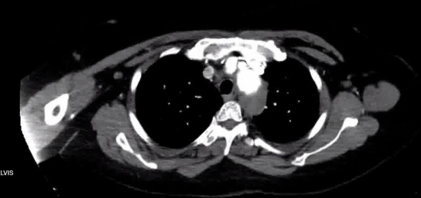 Aortic Dissection (Radiopaedia 85272-100847 A 12).jpg