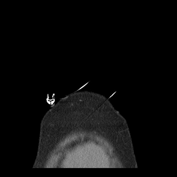 File:Aortic arch graft infection (FDG PET-CT) (Radiopaedia 71975-82437 Coronal 3).jpg