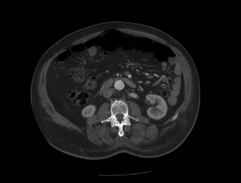 File:Aortic dissection (Radiopaedia 28802-29105 A 62).jpg
