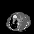 Aortic dissection (Radiopaedia 68763-78691 A 19).jpeg