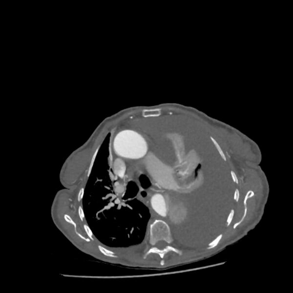 File:Aortic dissection (Radiopaedia 68763-78691 A 19).jpeg