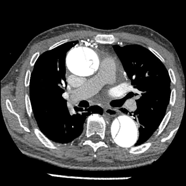 File:Aortic dissection - DeBakey Type I-Stanford A (Radiopaedia 79863-93115 A 16).jpg