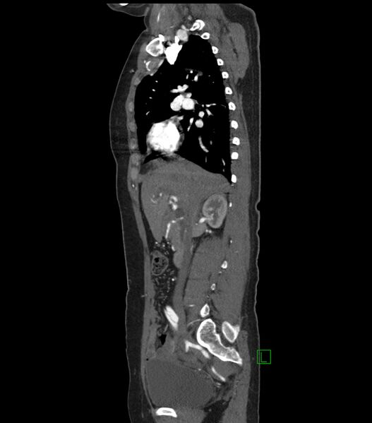 File:Aortic dissection with renal ischemia (Radiopaedia 76573-88338 D 7).jpg