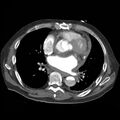 Aortic dissection with rupture into pericardium (Radiopaedia 12384-12647 A 33).jpg
