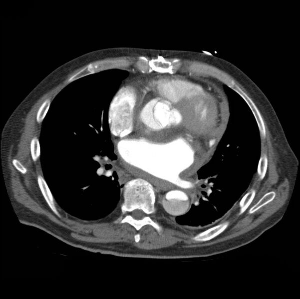File:Aortic dissection with rupture into pericardium (Radiopaedia 12384-12647 A 33).jpg
