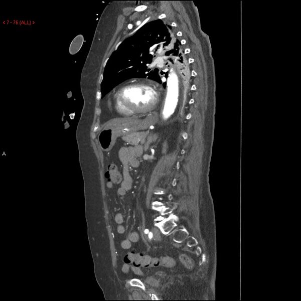 File:Aortic intramural hematoma (Radiopaedia 27746-28001 C 45).jpg