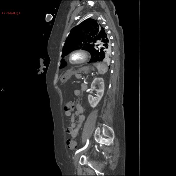 File:Aortic intramural hematoma (Radiopaedia 27746-28001 C 53).jpg