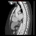 Aortic valve stenosis (Radiopaedia 14480-14423 B 1).jpg