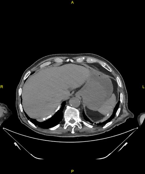 File:Aortoenteric fistula (Radiopaedia 84308-99603 Axial non-contrast 39).jpg