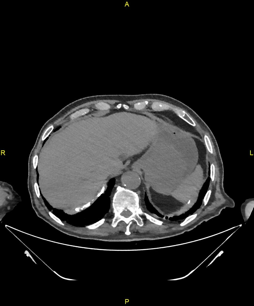 Aortoenteric fistula (Radiopaedia 84308-99603 Axial non-contrast 39).jpg