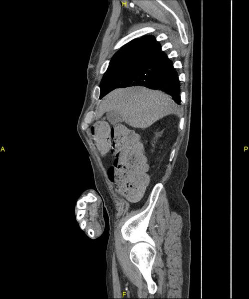 File:Aortoenteric fistula (Radiopaedia 84308-99603 C 65).jpg
