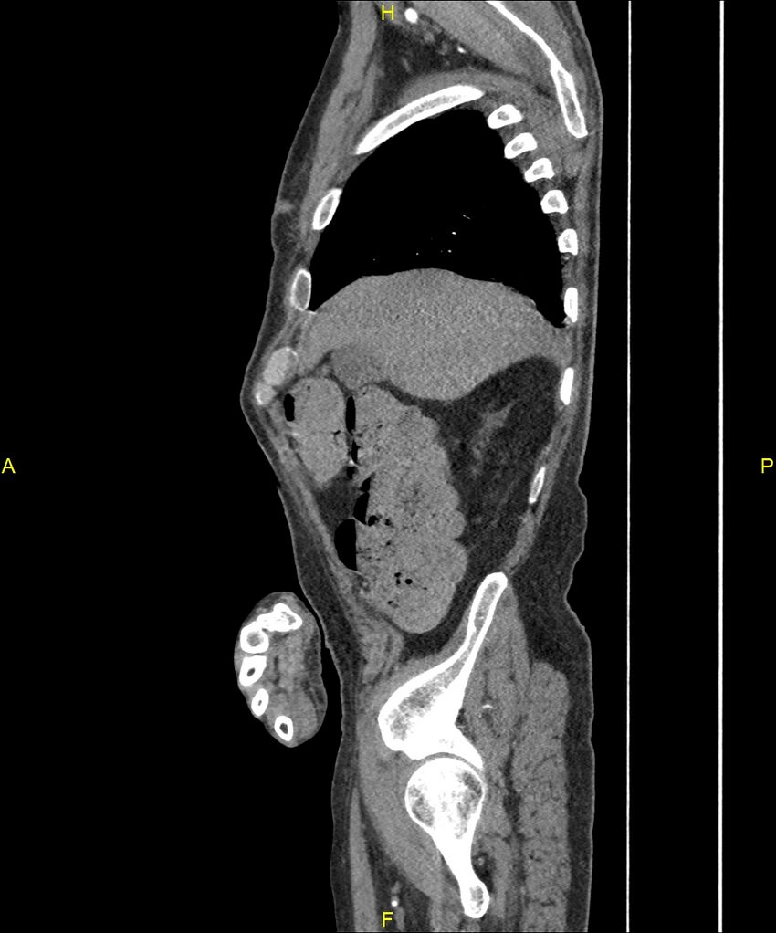 Aortoenteric fistula (Radiopaedia 84308-99603 C 65).jpg